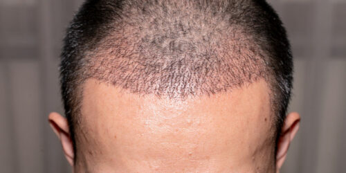 Hair Transplant – Types, Benefits, and Tips to Choose a Doctor