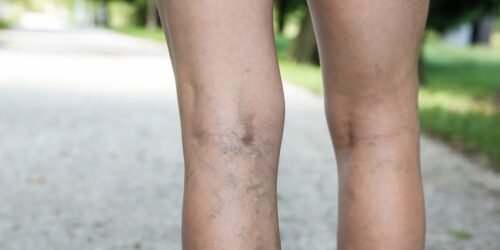 Understanding Spider Vein Treatment: Options for Clearer Skin