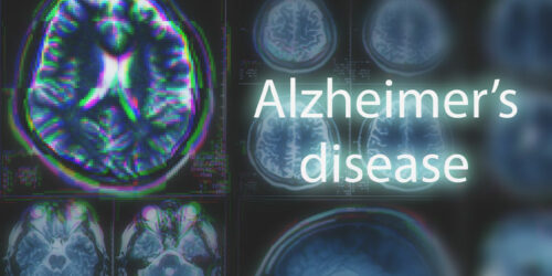 10 Early Signs of Alzheimer’s Disease