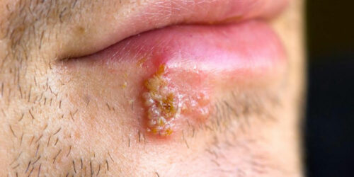 Blisters – Causes and how to heal blisters quickly