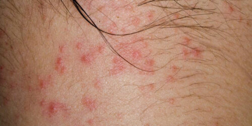 Here are a few common causes of atopic dermatitis