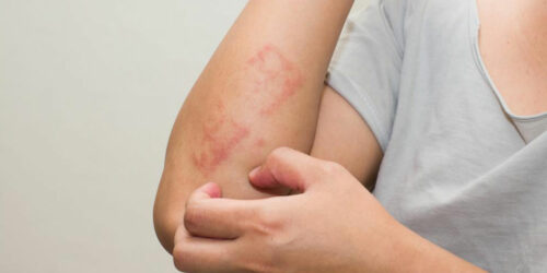 Here’s all that you need to know about scabies skin rash