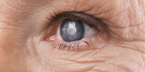 All You Need to Know about Cataract