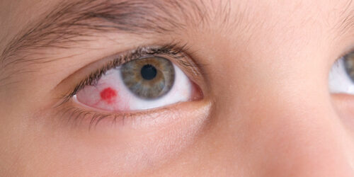 Eye infections – All you need to know