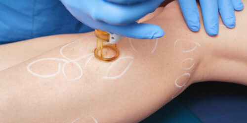 Here’s what you need to know about leg cellulitis treatment