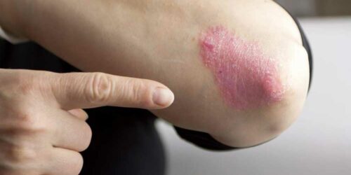 Home Remedies to Manage the Symptoms of Plaque Psoriasis