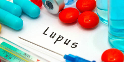 Lupus – An Overview