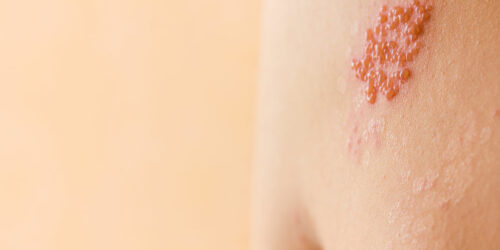 Symptoms and causes of shingles