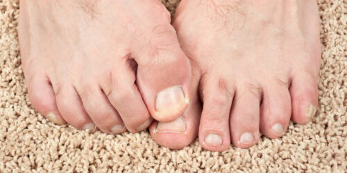 Some Effective Home Remedies for Toenail Fungus