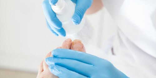 Toenail Fungus – Symptoms and Treatment Methods