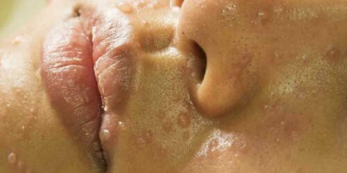 Treat Rosacea With These Natural Medicines and Remedies