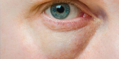 11 Easy Ways to Get Rid of Bags Under Eyes